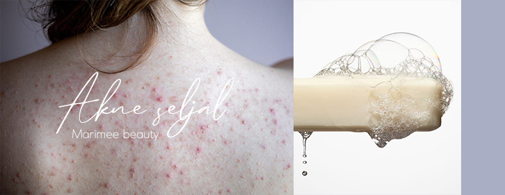  Akne seljal või dekolteel